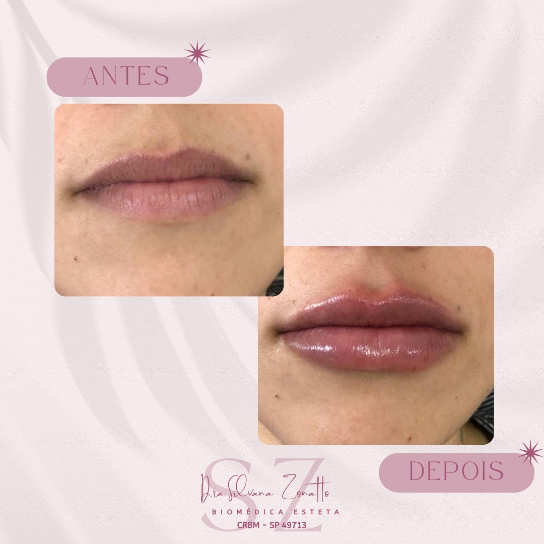 Preenchimento Labial